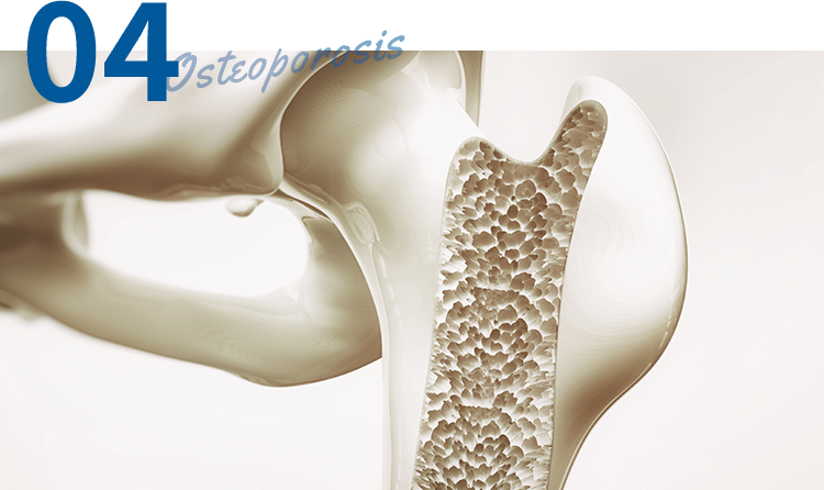 骨密度測定で骨粗鬆症を早期発見
